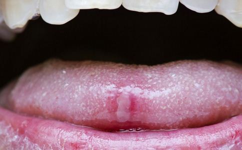 口腔潰瘍有什麼症狀 如何預防口腔潰瘍 口腔潰瘍的預防方法