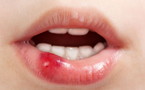 口腔潰瘍怎麼辦 口腔潰瘍為何反復發作 口腔反復長潰瘍的原因