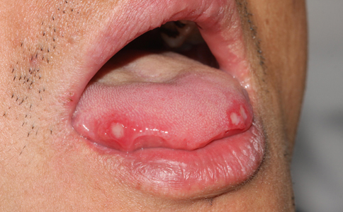 口腔潰瘍吃什麼好 口腔潰瘍的偏方 口腔潰瘍的症狀