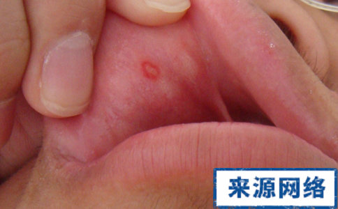 口腔潰瘍有哪些症狀 口腔潰瘍常見症狀是什麼 口腔潰瘍症狀
