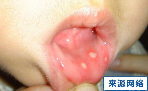 為什麼經常口腔潰瘍 兒童口腔潰瘍 寶寶口腔潰瘍的原因