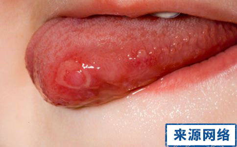口腔潰瘍會癌變嗎 口腔潰瘍癌變症狀 口腔潰瘍的症狀