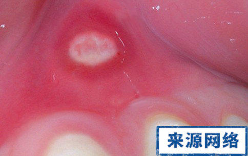 口腔潰瘍 口腔潰瘍癌變症狀 口腔潰瘍症狀