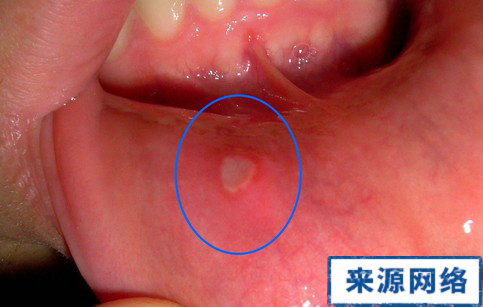 口腔潰瘍治療方法 經常口腔潰瘍 口腔潰瘍怎麼辦