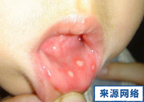 口腔潰瘍的症狀 口腔潰瘍症狀圖片 口腔潰瘍的表現
