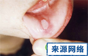口腔潰瘍 雌激素 葉酸 口腔潰瘍為什麼老愛復發 根治