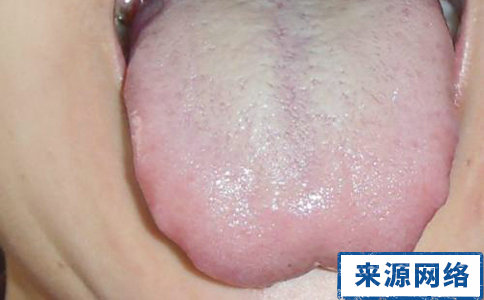 口臭舌苔厚是怎麼回事 舌苔厚的原因是什麼 口臭舌苔後有哪些原因