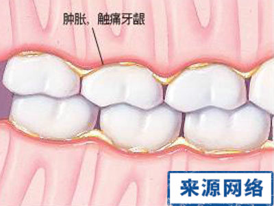 牙龈腫痛的原因 牙龈腫痛是什麼原因 牙龈腫痛怎麼辦