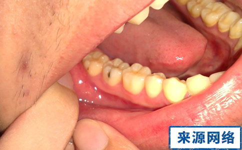 如何診斷蛀牙 蛀牙有哪些階段 如何看蛀牙嚴重程度