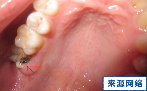 如何診斷蛀牙 如何治療蛀牙 治療蛀牙方法有哪些