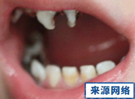 孩子蛀牙怎麼辦 蛀牙怎麼治療 蛀牙的治療方法