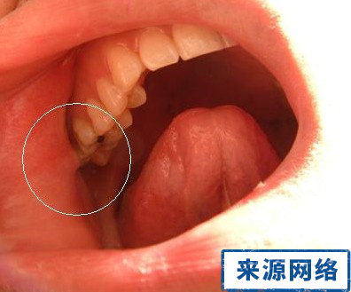 蛀牙有什麼症狀 蛀牙圖片 蛀牙怎麼辦