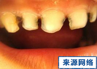 牙齒蛀牙嚴重圖 蛀牙疼怎麼辦 有蛀牙怎麼辦
