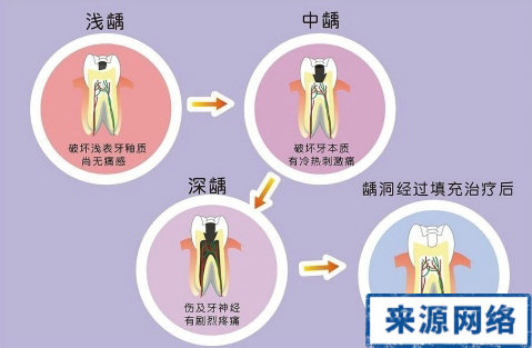 蛀牙圖片 蛀牙的形成圖片 蛀牙形成過程圖片