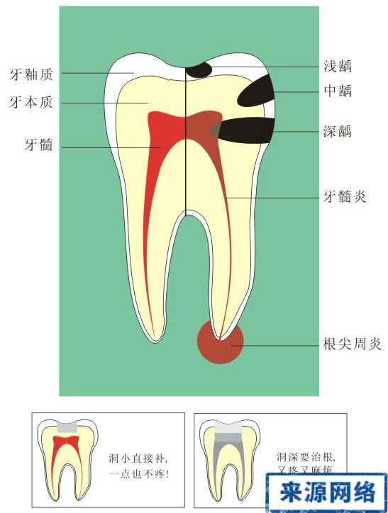 蛀牙圖片 蛀牙的形成圖片 蛀牙形成過程圖片