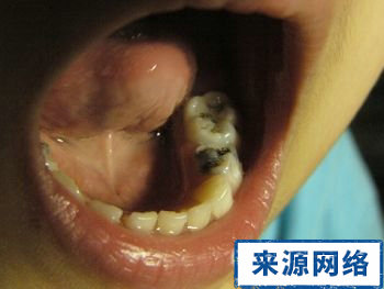 爛牙 口腔黏膜 牙齒 預防黏膜癌變 牙齒蛀壞 產生爛牙的原因 潰瘍