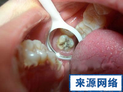 齲齒 病因 治療 蛀牙 細菌 飲食 牙齒