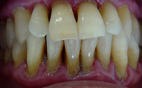 牙周炎患者該如何飲食 牙周炎患者的飲食方法 牙周炎患者吃什麼