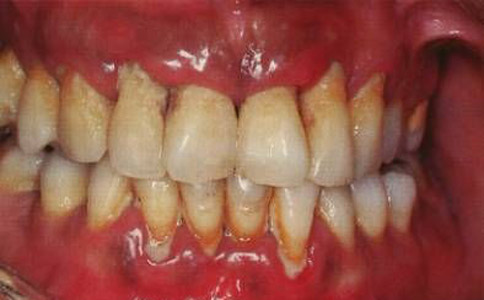 牙周炎的症狀有哪些 牙周炎的症狀是什麼 牙周炎該如何護理