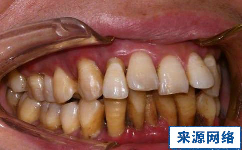 牙周炎症狀 牙周炎圖片 牙周炎治療方法