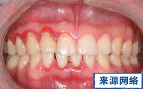 牙周炎治療方法 牙周炎症狀 牙周炎圖片