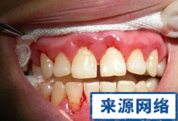 牙周炎的症狀 牙周炎圖片 牙周炎有什麼症狀
