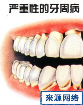 牙周炎症狀 牙周炎的症狀 牙周炎圖片