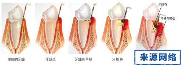 牙周炎圖片 牙周炎的圖片 牙周炎檢查圖片