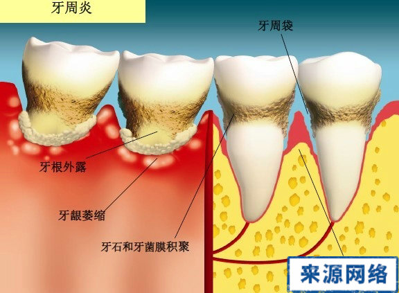 牙周炎症狀 牙周炎圖片 牙周炎症狀圖片
