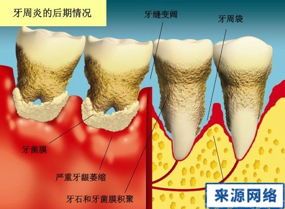 牙周炎症狀 牙周炎圖片 牙周炎症狀圖片