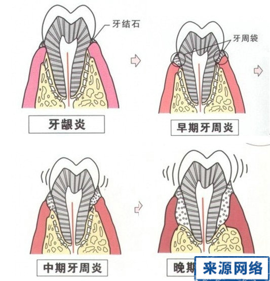 牙周炎症狀 牙周炎圖片 牙周炎