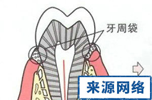 牙周炎 牙周炎的演變 牙周疾病 牙齒松動