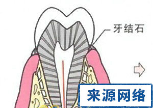 牙周炎 牙周炎的演變 牙周疾病 牙齒松動
