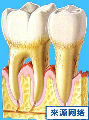 治療牙周炎 有效治牙周炎 牙周炎的治療