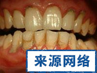 菌斑 牙龈 牙骨質 牙龈出血 牙周袋溢膿