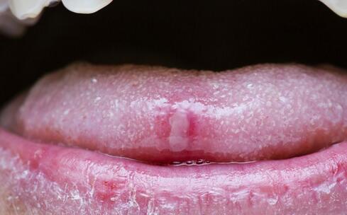 如何預防預防嘴唇干裂 預防預防嘴唇干裂的方法 預防嘴唇干裂怎麼預防