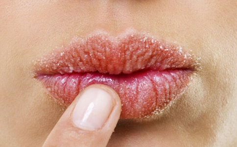 嘴唇干裂怎麼辦 嘴唇干裂怎麼治療 嘴唇干裂如何預防