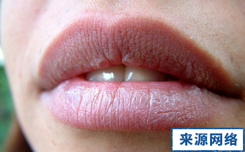 嘴唇老是干裂怎麼回事 什麼原因會導致嘴唇干裂 為什麼會嘴唇干裂