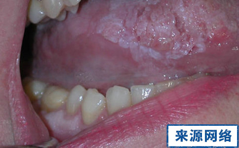 口腔扁平苔藓有哪些症狀 口腔扁平苔藓症狀有哪些 口腔扁平苔藓症狀