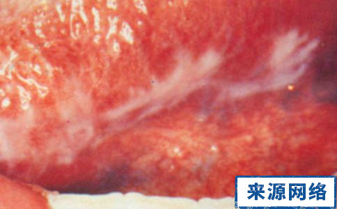口腔扁平苔藓的分類症狀 口腔扁平苔藓症狀 口腔扁平苔藓