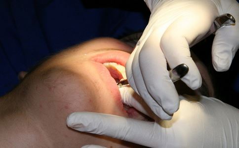 拔牙後如何護理 拔牙後有什麼護理方法 拔牙有什麼禁忌