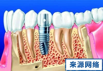 補牙 補牙的過程 如何補牙