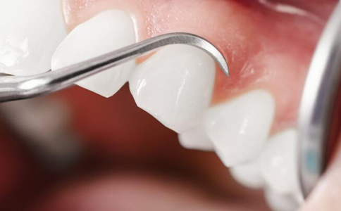 什麼牙齒可以做烤瓷牙 做了烤瓷牙應該如何護理 烤瓷牙的護理方法