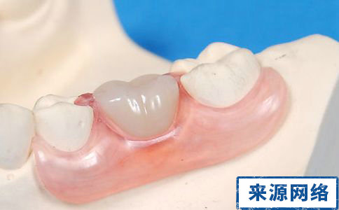 鑲牙的過程 拔牙後什麼時候鑲牙 什麼時候鑲牙好