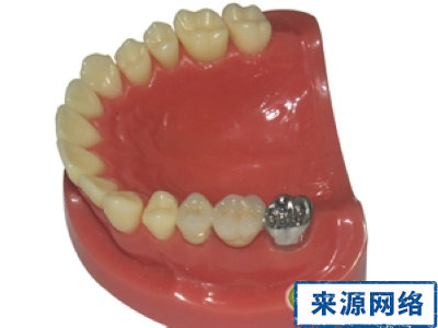 烤瓷牙 烤瓷牙的保護 烤瓷牙日常護理 如何鑒別烤瓷牙質量